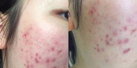 有效去除青春痘的终极方法（告别痘痘的秘诀）